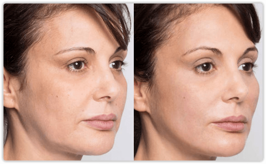 Thread Lift Face Lift procedures in Toronto & Mississauga Lip Doctor